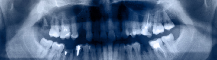 root-canal-banner