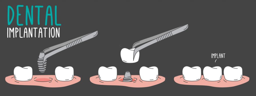 Dental Implants process