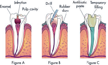 tooth-ache-figure-1