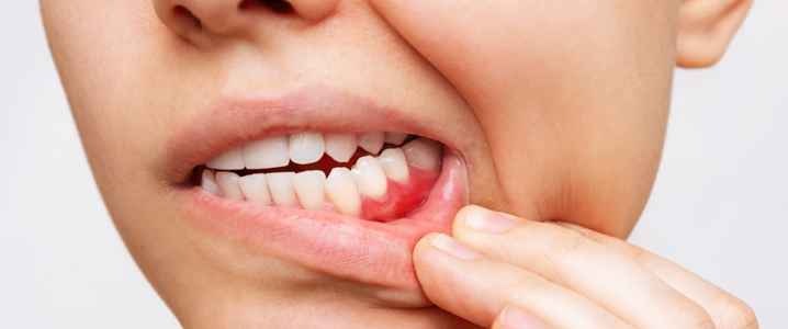 What Causes Gum Disease And Can It Be Treated Regent Dental Centre