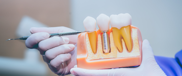 Dentist holding a model of a dental implant, pointing toward the titanium root