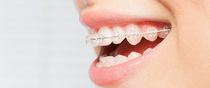 Close up of woman's teeth with clear wired invisible braces